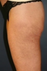 Feel Beautiful - Thigh Cellulite Thermi-RF treatment - After Photo